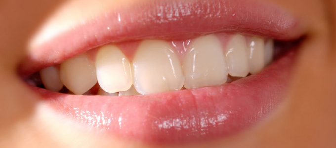 Fratura Dental Fratura Dental