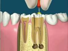 endodontia